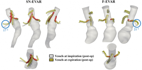 Images of Respiratory-induced deformation of the renovisceral arteries