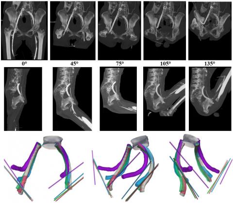 Lateral images of iliofemoral venous stents